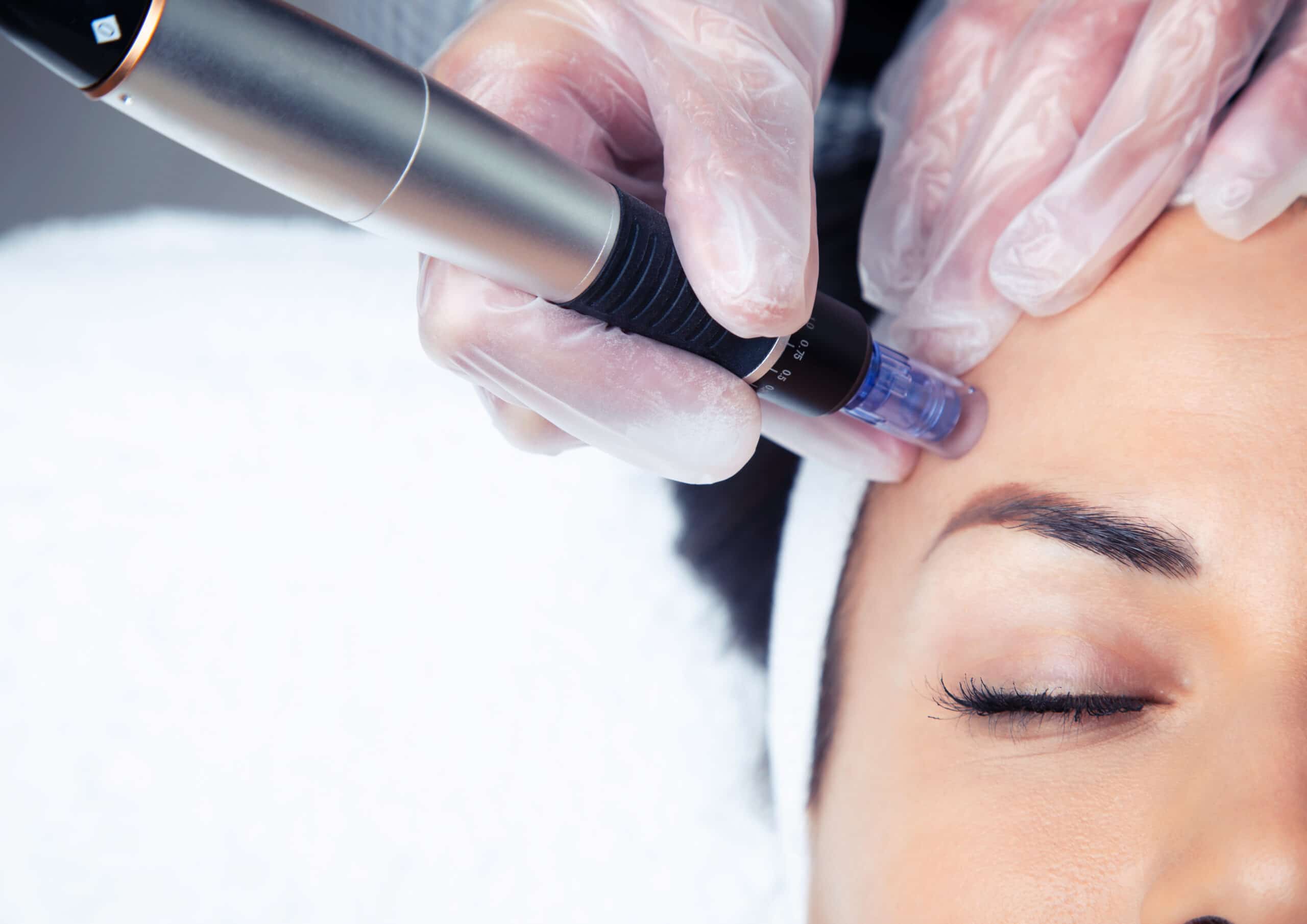 close up of woman getting microneedling