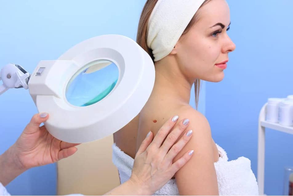 mole removal woman smiling getting microneedling