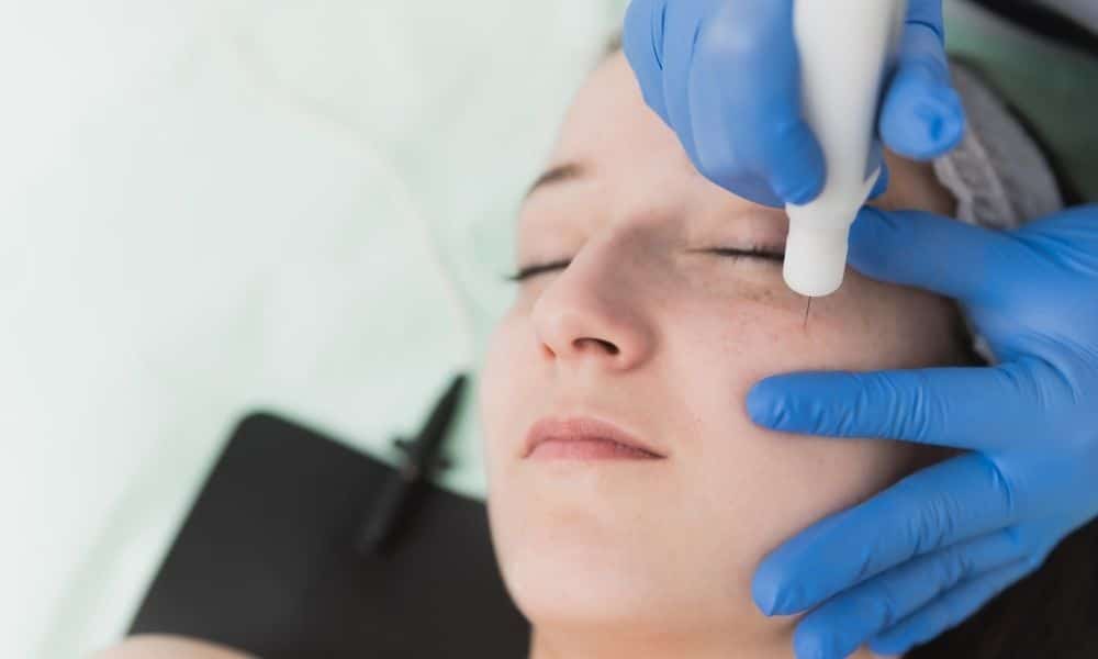 woman smiling getting microneedling