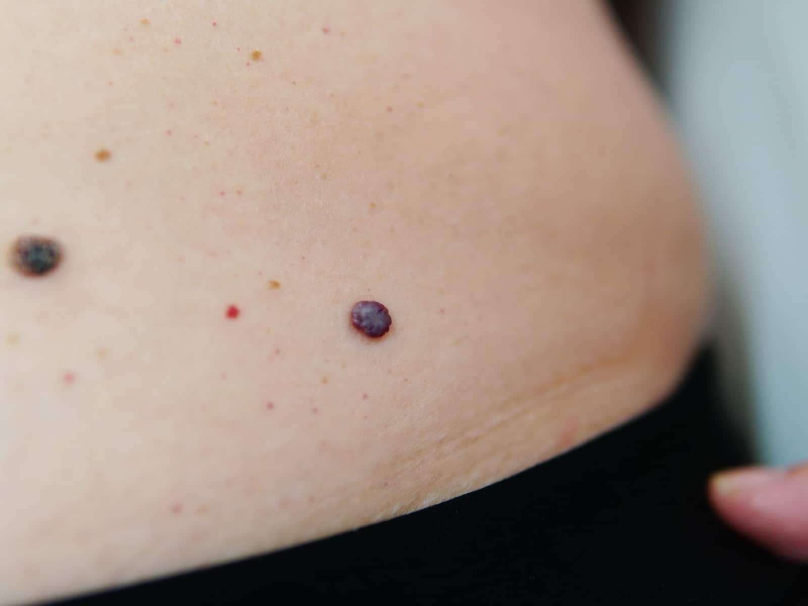Untitled (1) Close-up of a section of skin with several moles. One prominent mole is dark and slightly raised, surrounded by lighter ones and small freckles. The edge of dark clothing is visible at the bottom of the image.