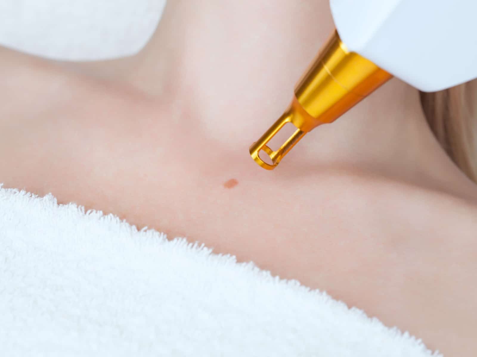 Untitled (1) A close-up of a person receiving a laser treatment on a mole near the collarbone. The skin is partially covered with a white towel, and a golden laser device targets the mole.