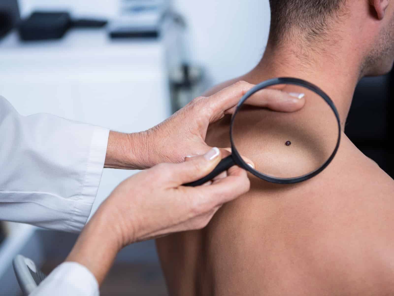 Untitled A close-up of a person holding a magnifying glass over a mole on another persons bare back, examining it for medical analysis. The setting appears to be a clinical environment.