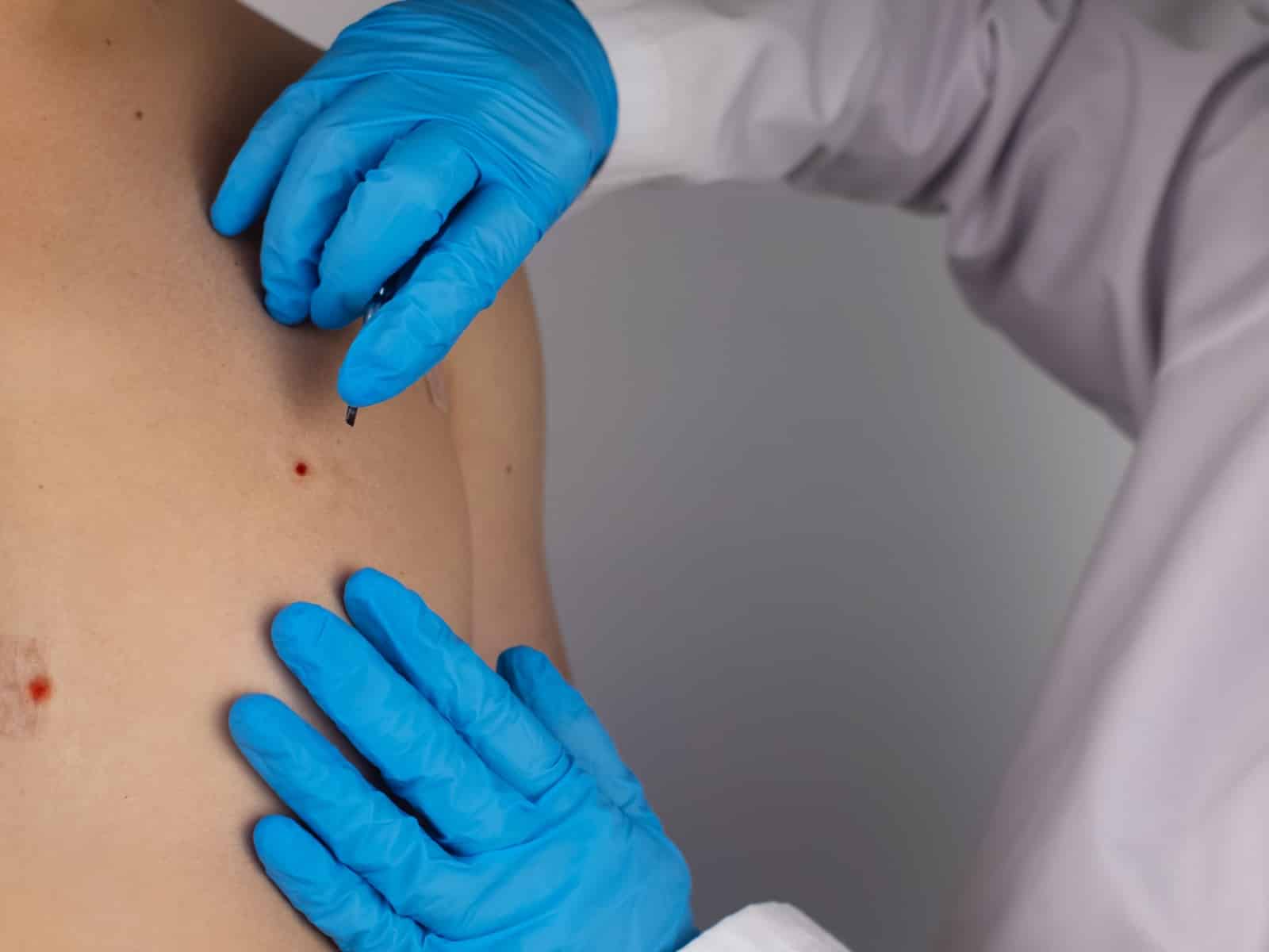 Untitled A medical professional wearing blue gloves examines moles on a persons back. A tool is being used to inspect the skin.