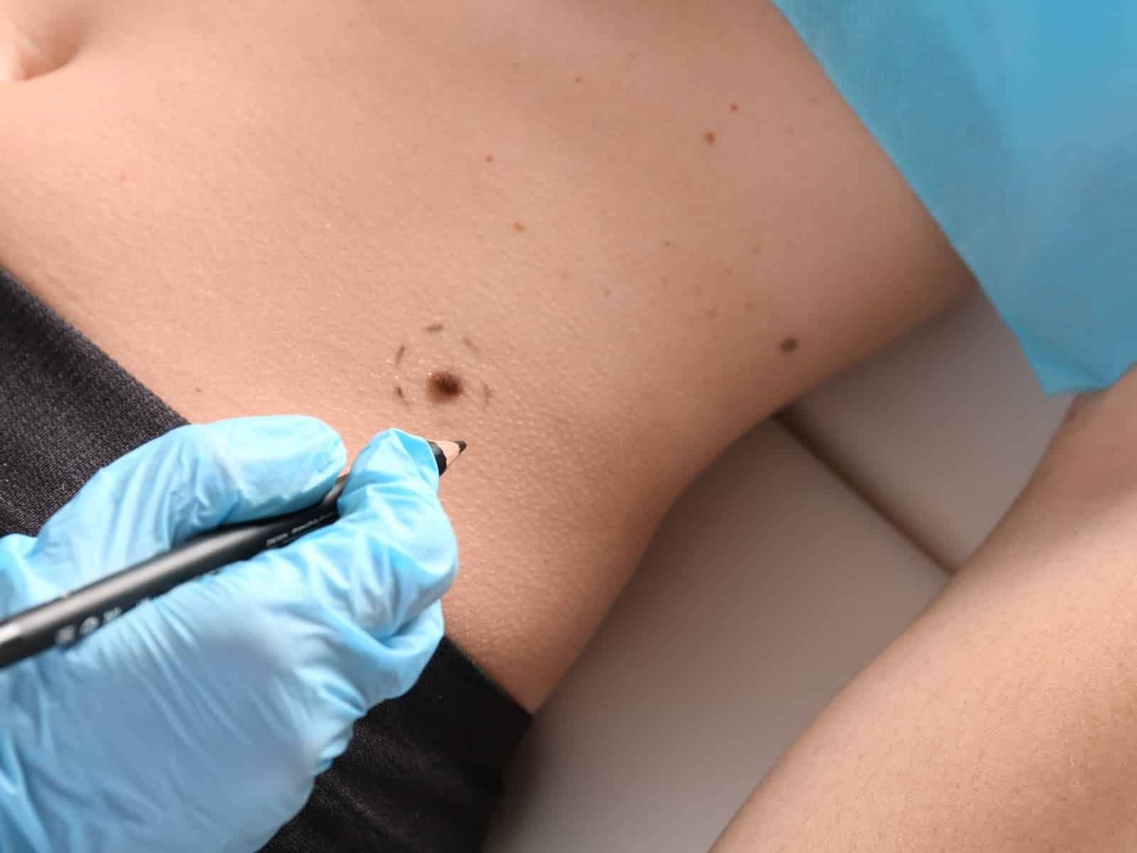 Untitled A gloved hand holding a pen marks the skin around a mole on a persons abdomen, possibly preparing for a medical examination or procedure. The person is lying down, partially covered by a blue drape, with dark clothing visible.