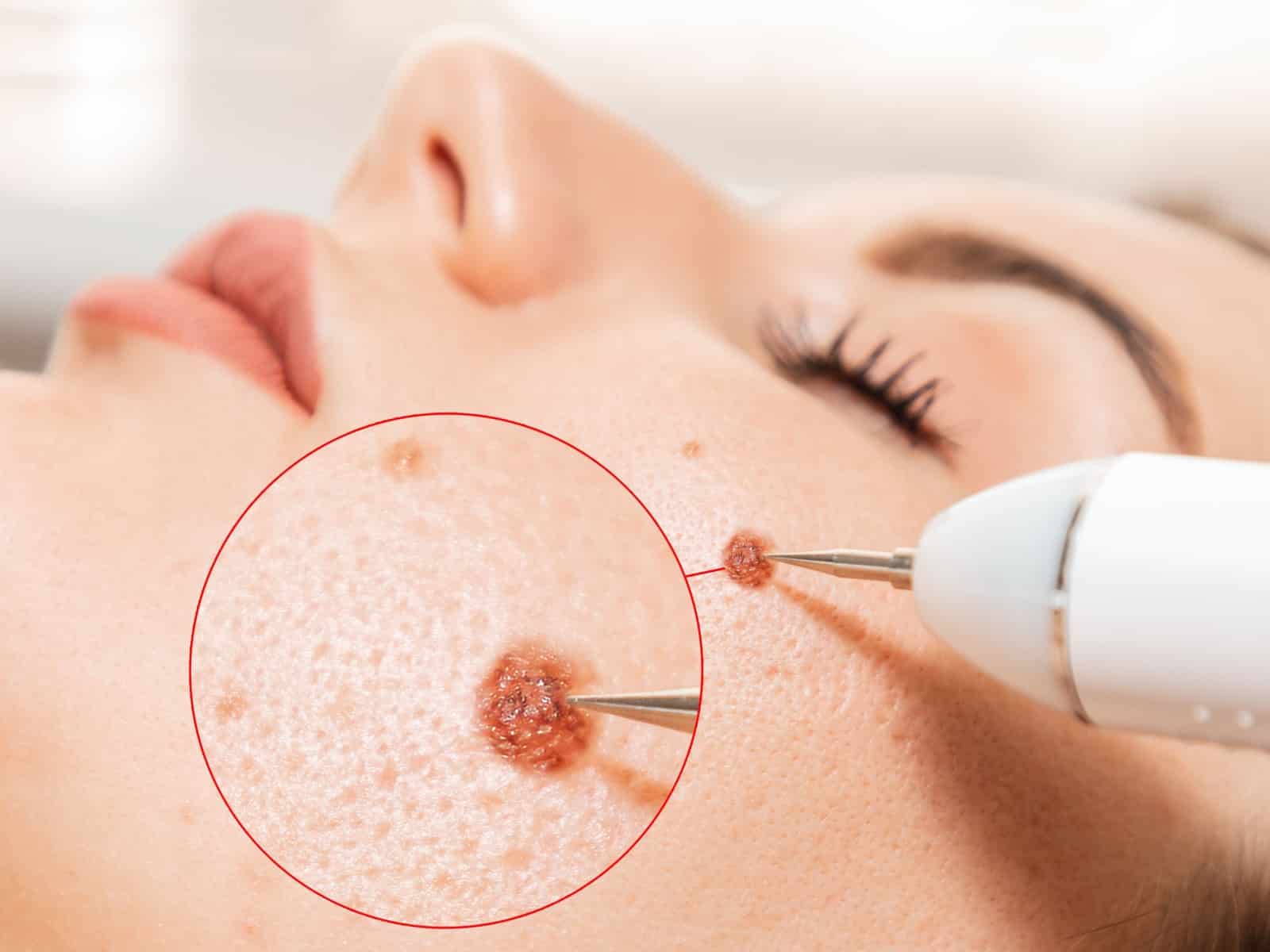 Close-up of a persons face undergoing a skin treatment. A circular magnified area shows a mole being removed by a medical tool. The person has closed eyes, and the treatment focuses on a mole on the cheek.