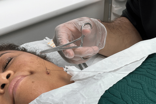 1 A person lies on a medical table while a healthcare professional in gloves uses scissors to cut a stitch on their cheek near the jawline. The area is covered with gauze and the person appears calm.