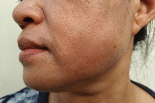 Healthium Web images Close-up of a womans face showing uneven skin tone, visible pores, and some hyperpigmentation on the cheek and jawline.