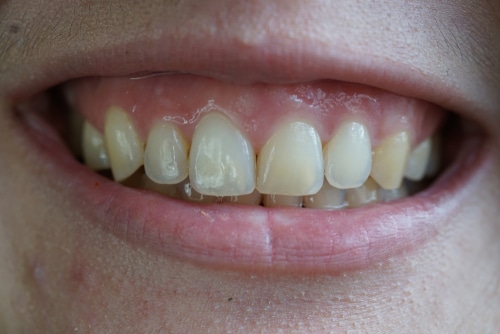 Close-up of a persons mouth smiling, showing upper and lower teeth. The teeth appear slightly uneven with some discoloration and visible gum tissue above the upper teeth.