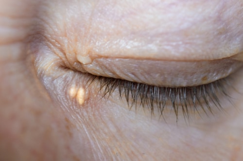 A close-up of a closed eye with two small, yellowish bumps on the lower eyelid near the inner corner, surrounded by wrinkled skin.