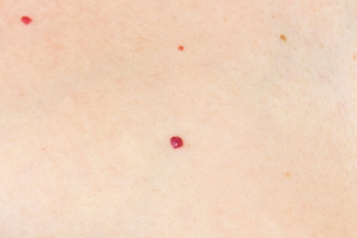 Close-up of light skin with a small, raised red mole or spot in the center and a few smaller spots nearby.