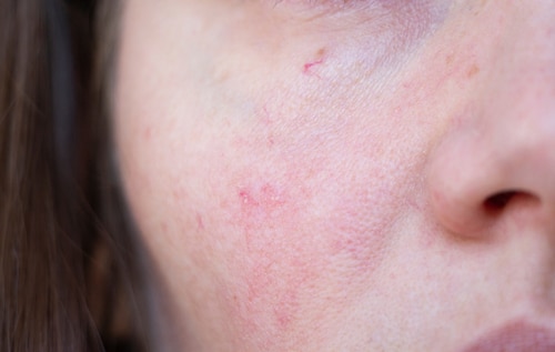Close-up of a persons cheek showing redness, small pimples, and irritated skin, possibly indicating acne or rosacea. The image focuses on the cheek and part of the nose.