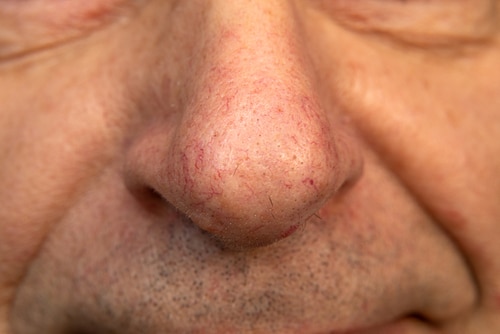 Close-up of a persons nose and upper lip, showing visible pores, skin texture, fine lines, and some redness and broken capillaries on the nose.