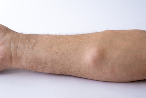 Lipoma,,A,Benign,Neoplasm,,A,Tumor,On,The,Forearm,Of A forearm with a visible lump or swelling under the skin, possibly indicating a cyst or lipoma, against a plain white background.