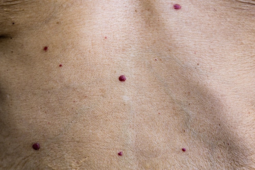 Close-up of human skin with several raised, small, dark red moles or growths scattered across the surface. The skin appears smooth and has a light complexion.