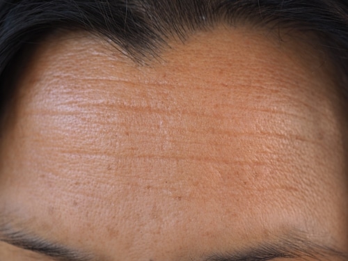 Asian,Woman,With,Wrinkles,On,The,Forehead.,Closeup,Photo,,Blurred. Close-up of a persons forehead with visible horizontal fine lines and wrinkles, showing natural skin texture and some uneven pigmentation. Eyebrows and hairline are partially visible at the top and bottom edges.