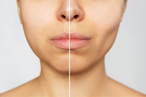 Cropped,Shot,Of,Young,Caucasian,Woman,Before,And,After,Plastic Close-up of a woman’s lower face divided by a vertical line, showing a comparison of skin tones or texture on each side, possibly illustrating before and after skincare or cosmetic treatment.