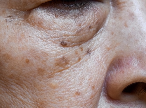 Small,Brown,Patches,Called,Age,Spots,On,Face,Of,Asian Close-up of an older person’s face showing skin with wrinkles, age spots, moles, and visible pores near the eye and nose. The skin appears textured and slightly uneven in tone.