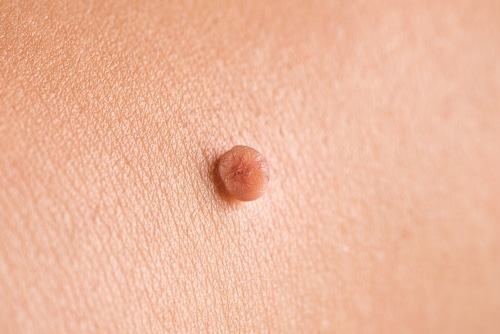 A close-up of human skin showing a raised, round, brown mole or skin growth with a slightly rough texture.