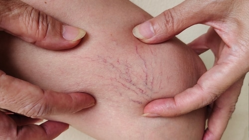 Close-up of hands gently holding a persons leg, showing visible spider veins beneath the skin.