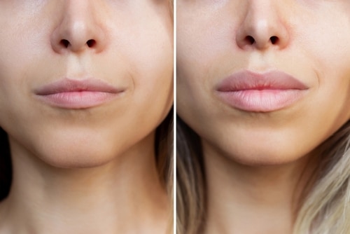 Result,Of,Lip,Augmentation.,Cropped,Shot,Of,Young,Blonde,Woman's Side-by-side comparison of a womans lower face showing lips before and after enhancement; the left image shows natural lips, while the right shows fuller, plumper lips.