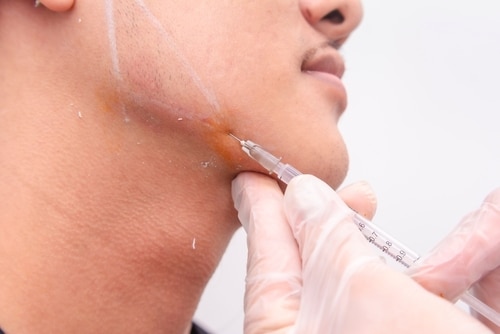Jawline,Filler,Procedure,For,Male,Patient.,Injecting,Filler,Gel,Or A close-up of a person receiving an injection in the jaw area. A gloved hand holds the syringe, and the skin is marked with white lines and an orange antiseptic. The persons face is partially visible.