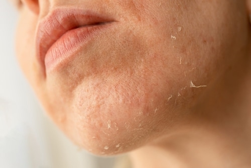Close-up of a person’s lower face and chin showing dry, flaky, and peeling skin, indicating possible dryness or irritation.