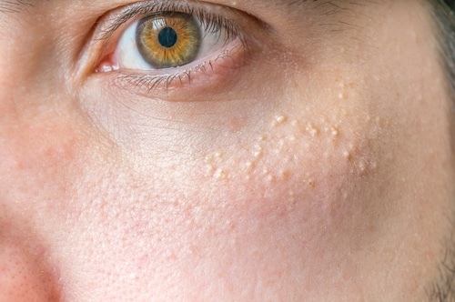A close-up of a persons face showing small, white bumps (milia) clustered on the skin beneath the eye. The skin texture and eye details are clearly visible.