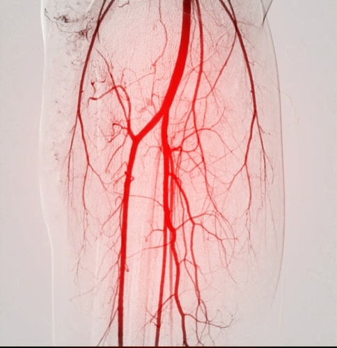 A,Femoral,Angiogram,Is,A,Medical,Procedure,Used,To,Visualize A medical angiogram image shows the blood vessels in a human leg, highlighting arteries and veins in red against a light background.