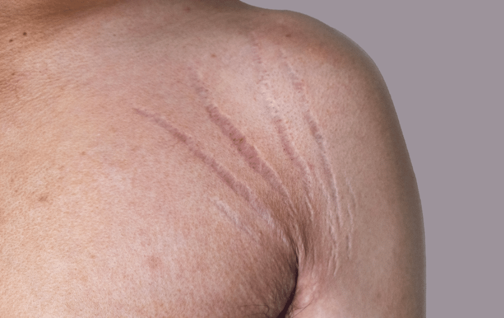 A woman lies in bed under a beige duvet, looking tired or unwell. Her right hand rests on her forehead, and she has a thoughtful expression. The setting appears to be a dimly lit bedroom with matching pillows.